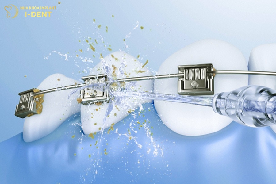 Sử dụng tăm nước để vệ sinh răng miệng sạch sẽ khi niềng răng khểnh