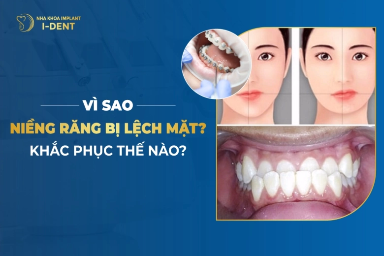 niềng răng bị lệch mặt