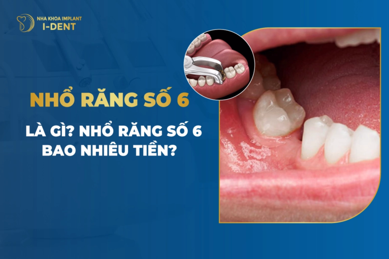 Nhổ răng số 6 giá bao nhiêu