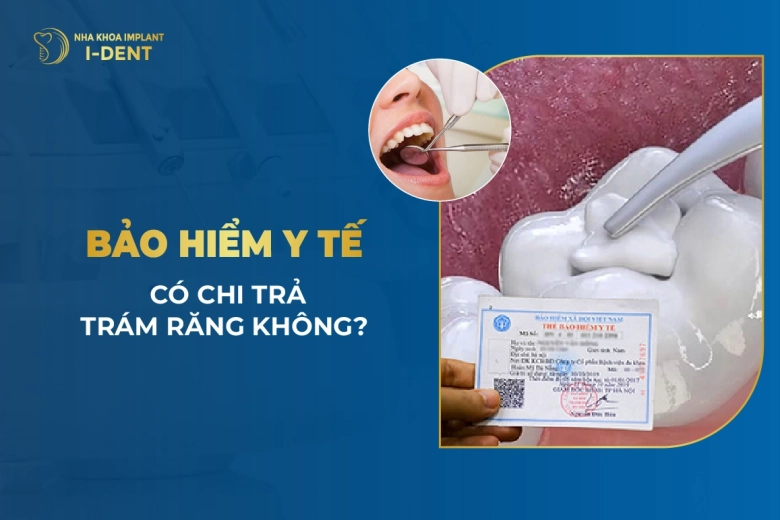 Bảo Hiểm Y Tế Có Chi Trả Trám Răng Không?