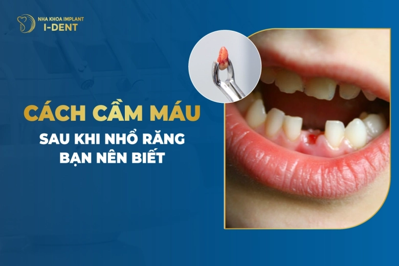 Cách Cầm Máu Sau Khi Nhổ Răng Bạn Nên Biết