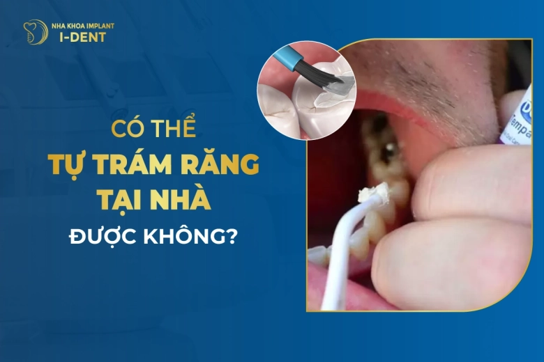 Có Thể Tự Trám Răng Tại Nhà Được Không?