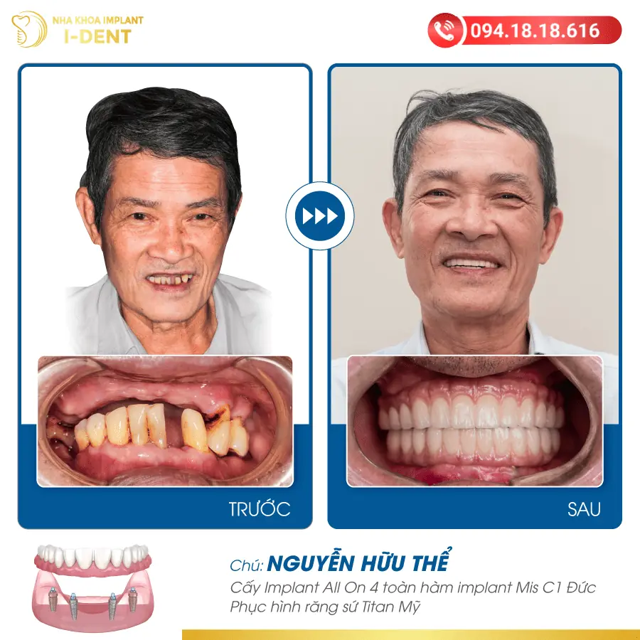Nguyen Huu The 01