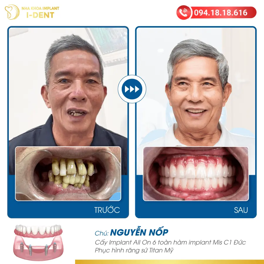 Nguyen Nop 01