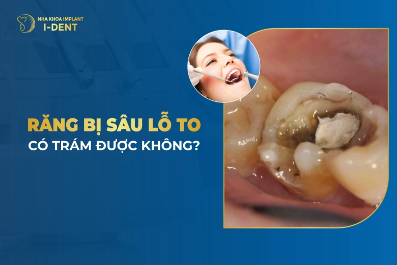 Răng Bị Sâu Lỗ To Có Trám Được Không?