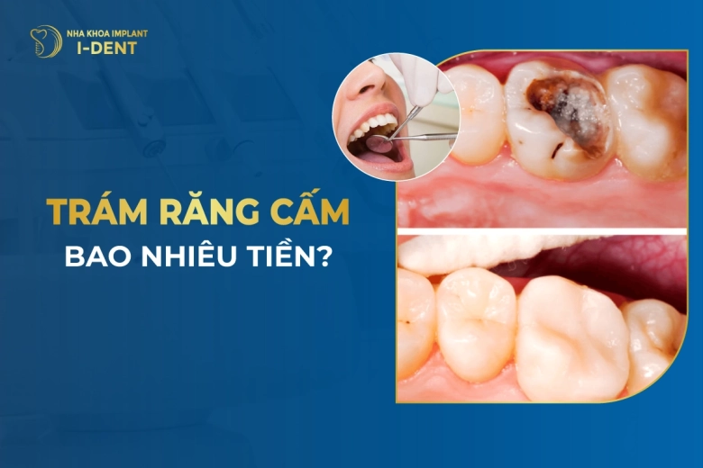 Trám Răng Cấm Bao Nhiêu Tiền?