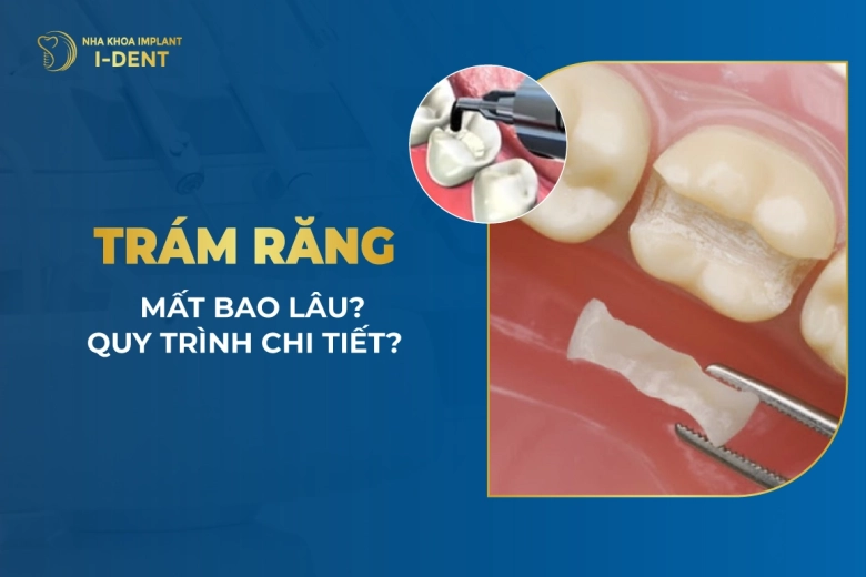 Trám Răng Mất Bao Lâu? Quy Trình Trám Răng