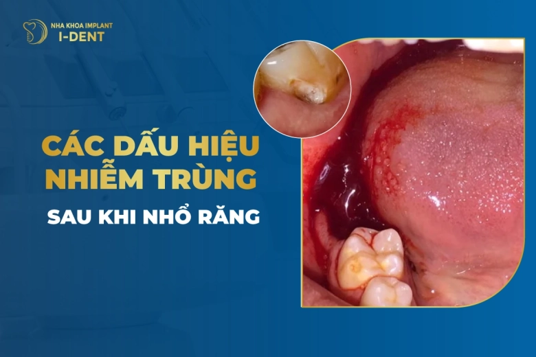 Các Dấu Hiệu Nhiễm Trùng Sau Khi Nhổ Răng
