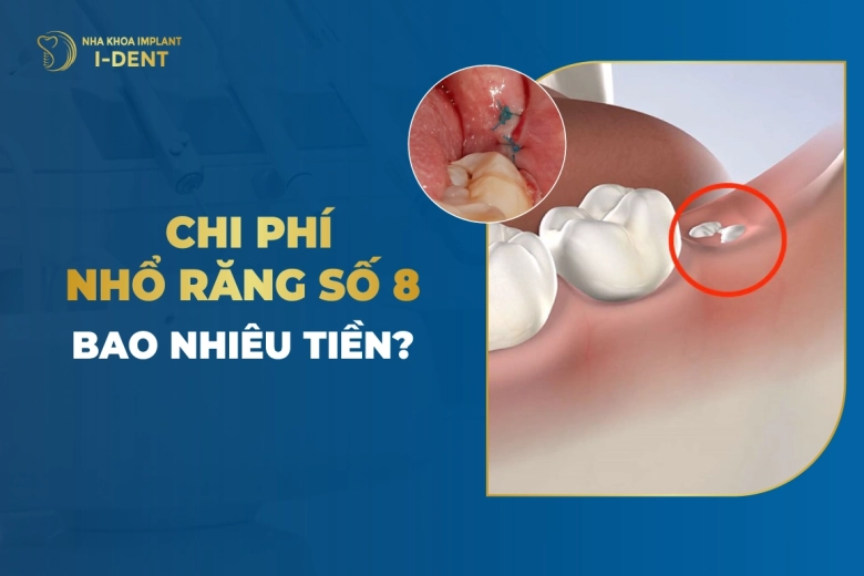 Chi Phí Nhổ Răng Số 8 Bao Nhiêu Tiền?