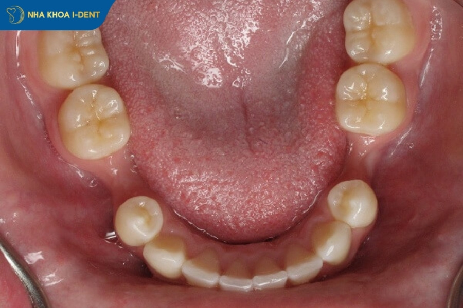 nhổ răng có ảnh hưởng gì đến sức khỏe