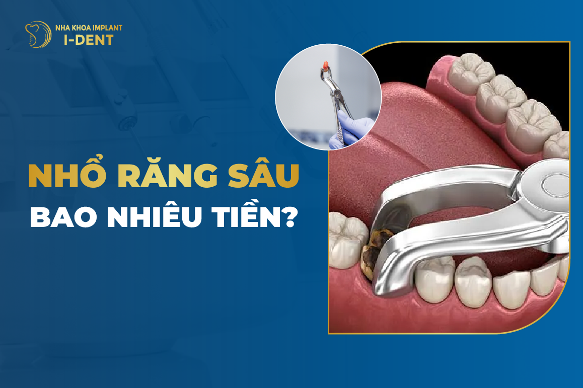 Nhổ Răng Sâu Bao Nhiêu Tiền?