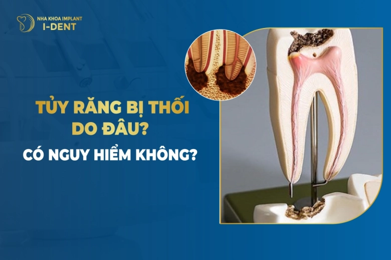 Tủy Răng Bị Thối Do Đâu? Có Nguy Hiểm Không?