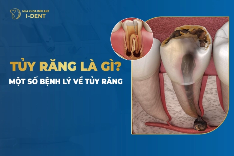 tuy-rang-la-gi-mot-so-benh-ly-ve-tuy-rang