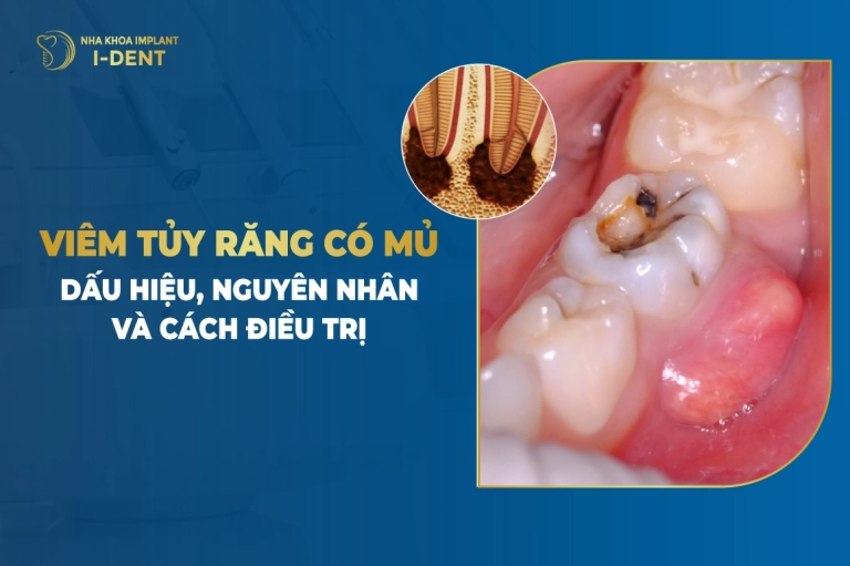viem-tuy-rang-co-mu