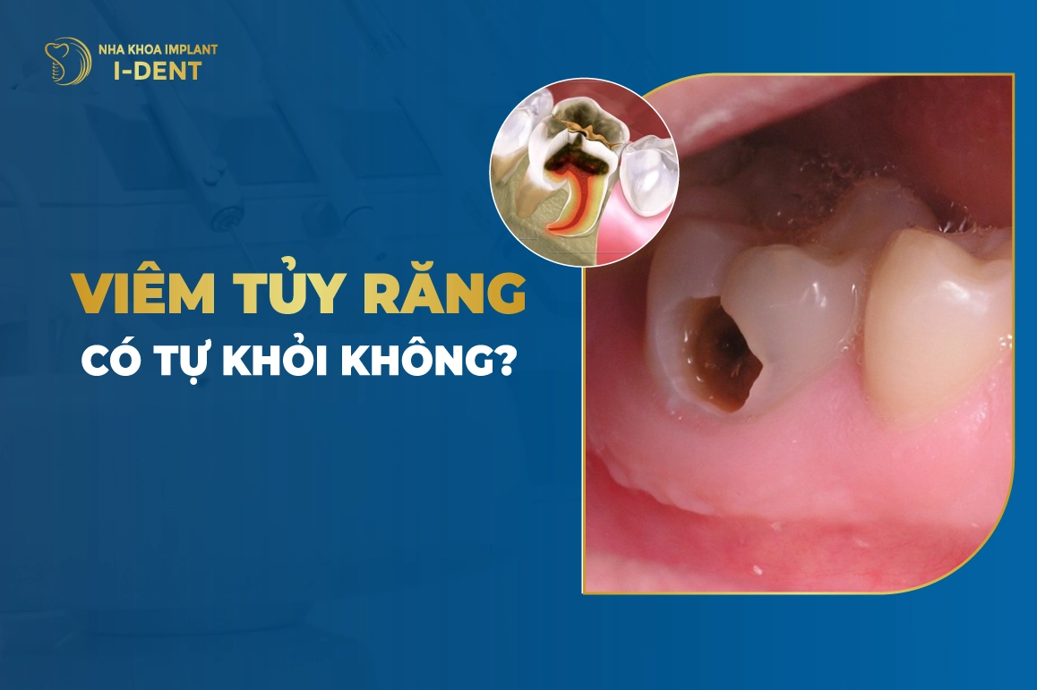 Viêm Tủy Răng Có Tự Khỏi Không?