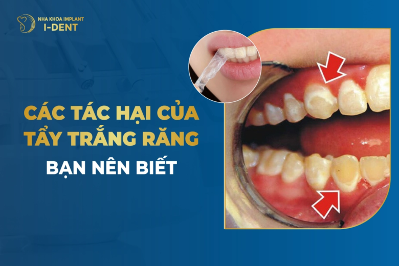 Các Tác Hại Của Tẩy Trắng Răng Bạn Nên Biết