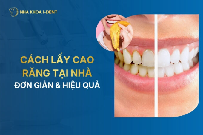 cách lấy cao răng tại nhà