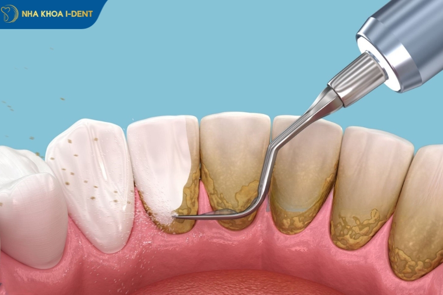 cách loại bỏ cao răng tại nhà