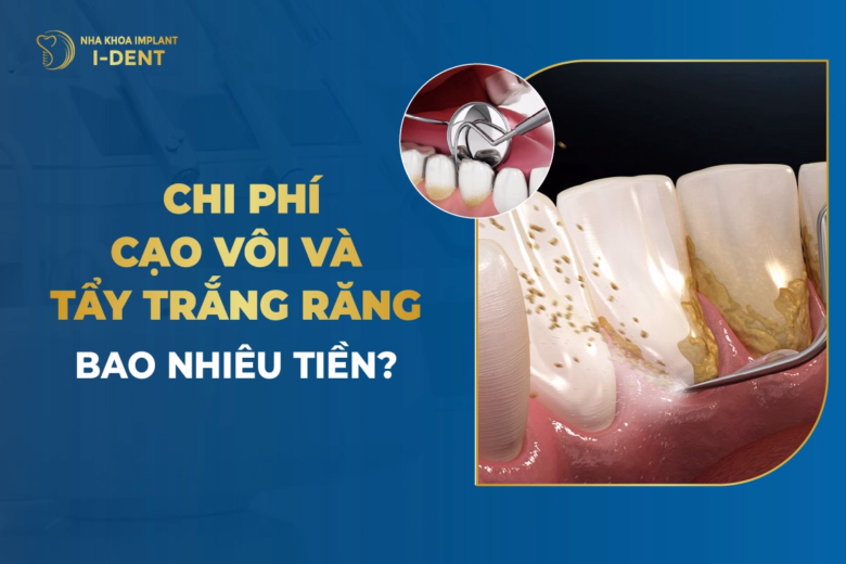 cao-voi-rang-va-tay-trang-rang-bao-nhieu-tien