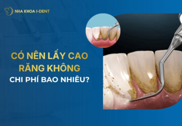 có nên lấy cao răng không