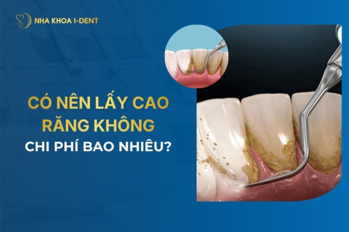 có nên lấy cao răng không