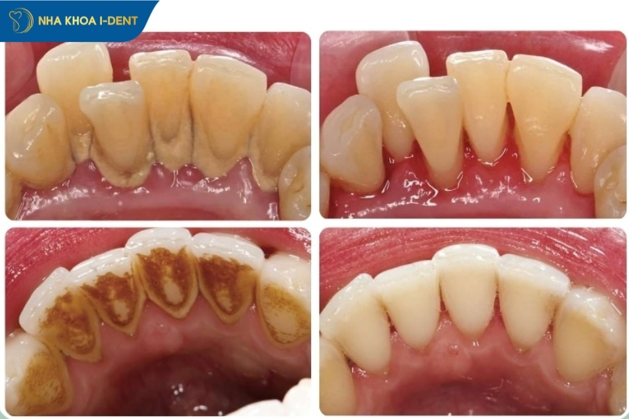 có nên lấy cao răng thường xuyên không