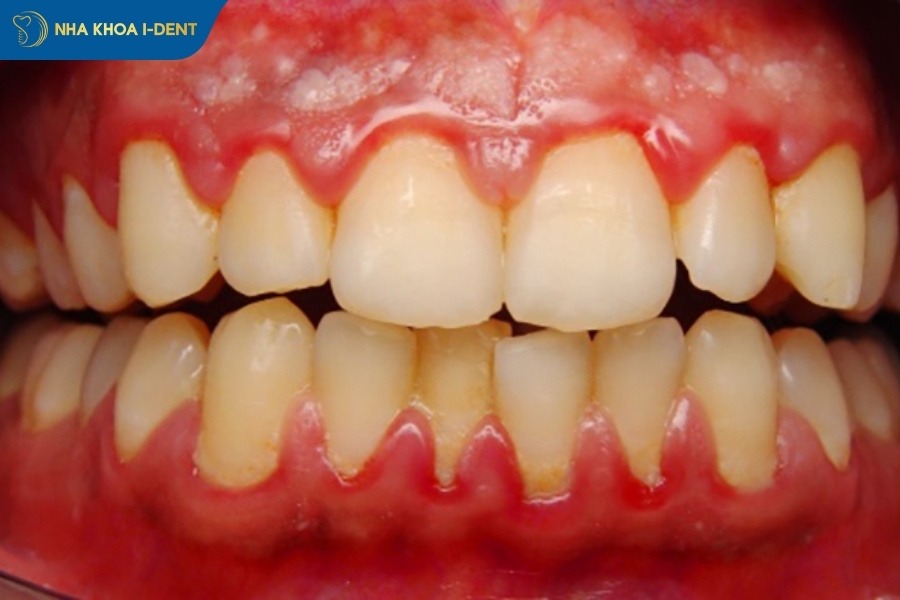 có nên tấy trắng răng không