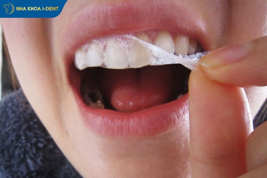 giá tẩy trắng răng