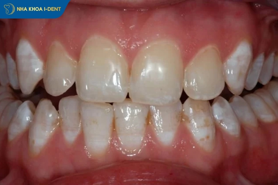 làm trắng răng có tốt không