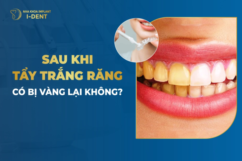 Sau Khi Tẩy Trắng Răng Có Bị Vàng Lại Không?