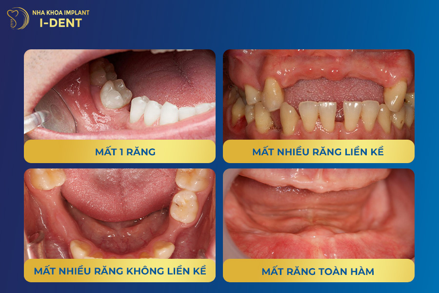 Cac-truong-hop-mat-rang-nen-cay-ghep-implant