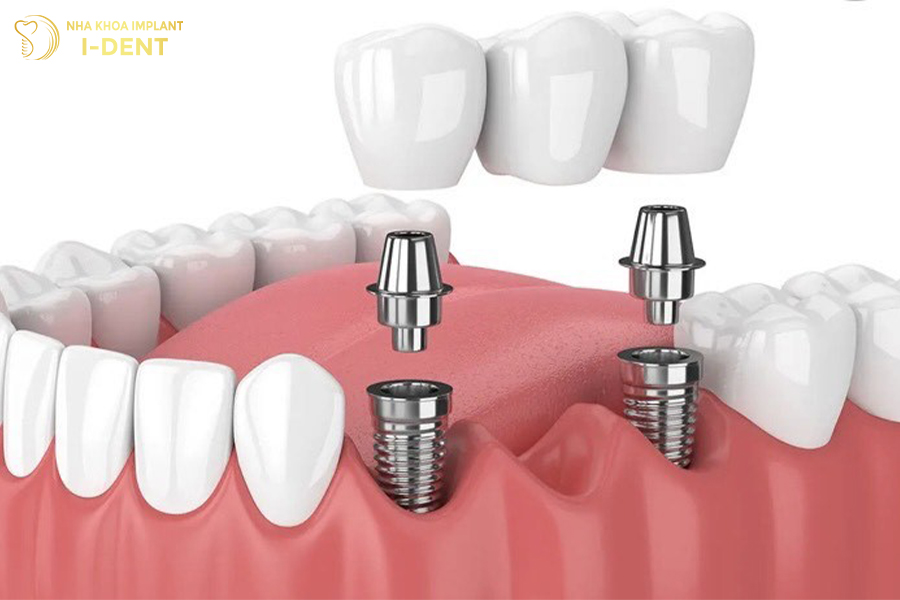 Cau-rang-su-tren-Implant