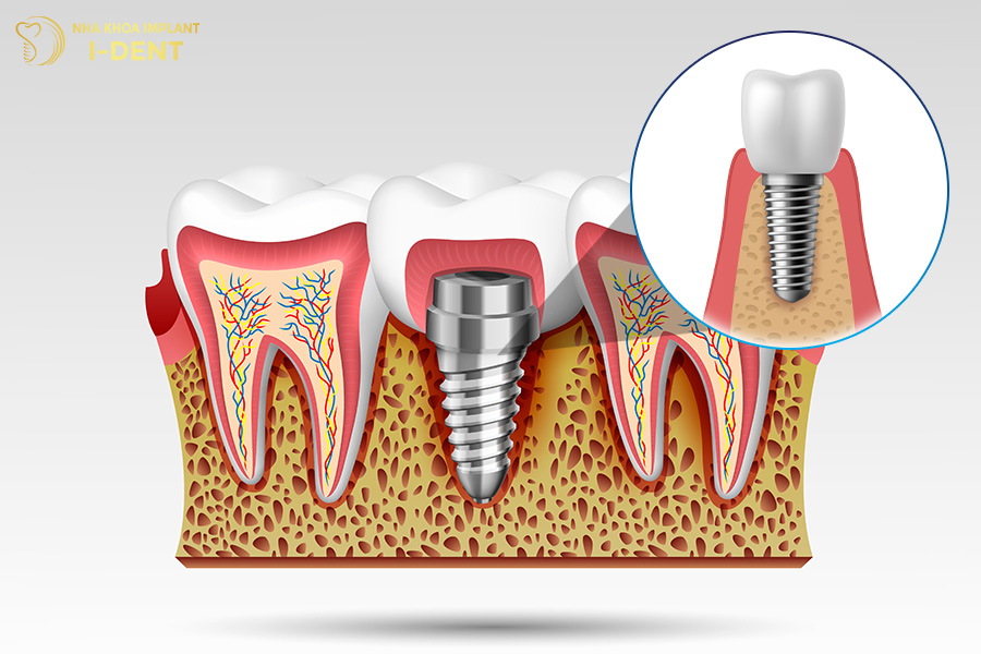 Chan-rang-Implant-giup-kich-thich-va-duy-tri-mat-do-xuong-ham-on-dinh