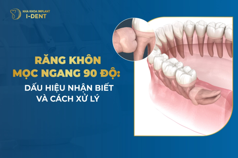 Răng Khôn Mọc Ngang: Dấu Hiệu Nhận Biết Và Cách Xử Lý