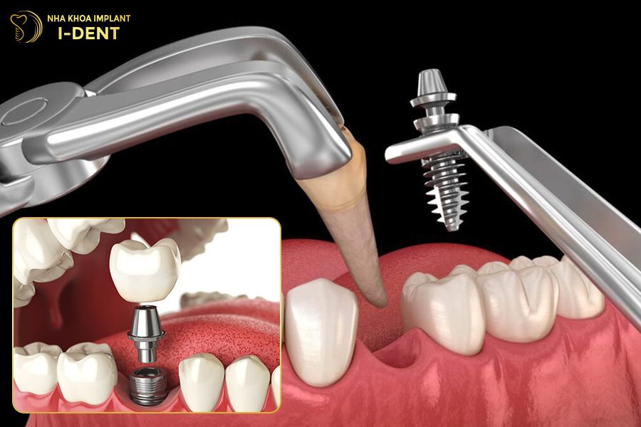 Sau-khi-nho-rang-co-the-cay-tru-Implant-tuc-thi