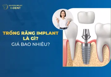 trồng răng implant