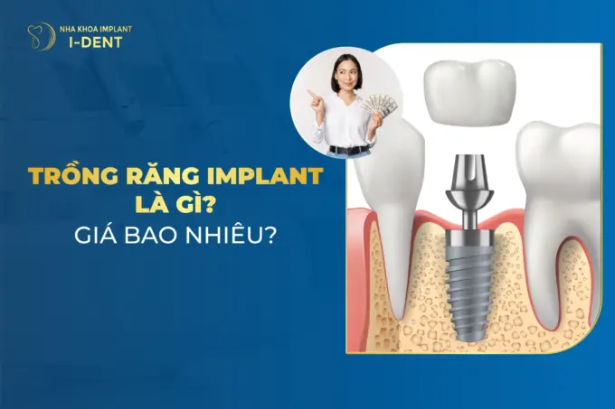 trồng răng implant