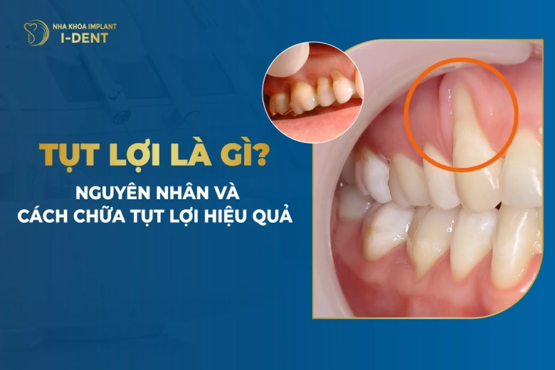 Tụt Lợi Là Gì? Nguyên Nhân Và Cách Chữa Tụt Lợi Hiệu Quả