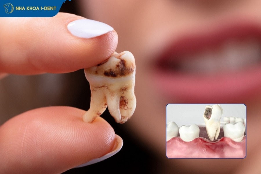 giá nhổ răng hàm bị sâu