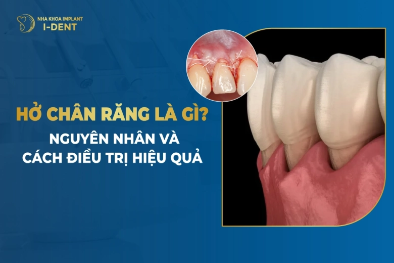 Hở Chân Răng Là Gì? Nguyên Nhân Và Cách Điều Trị Hiệu Quả