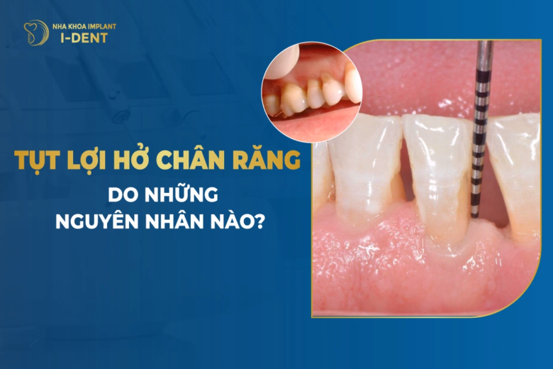 nguyen-nhan-tut-loi-ho-chan-rang