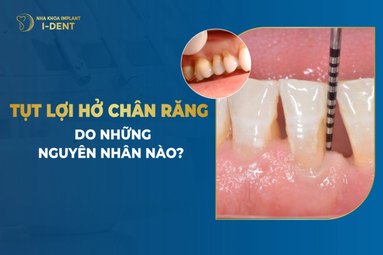 Tụt Lợi Hở Chân Răng Do Những Nguyên Nhân Nào?