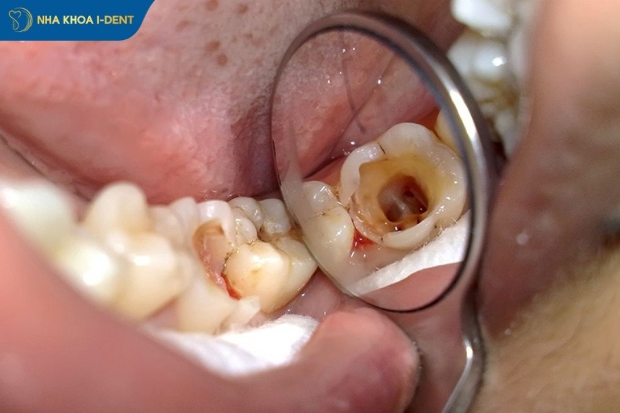 nhổ răng hàm bị sâu bao nhiêu tiền