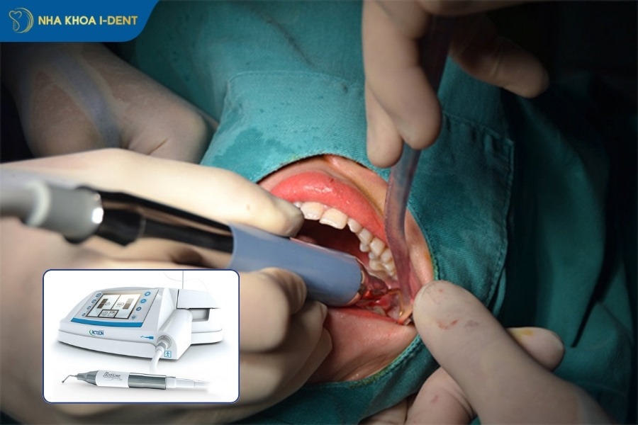 nhổ răng khôn bao nhiêu tiền