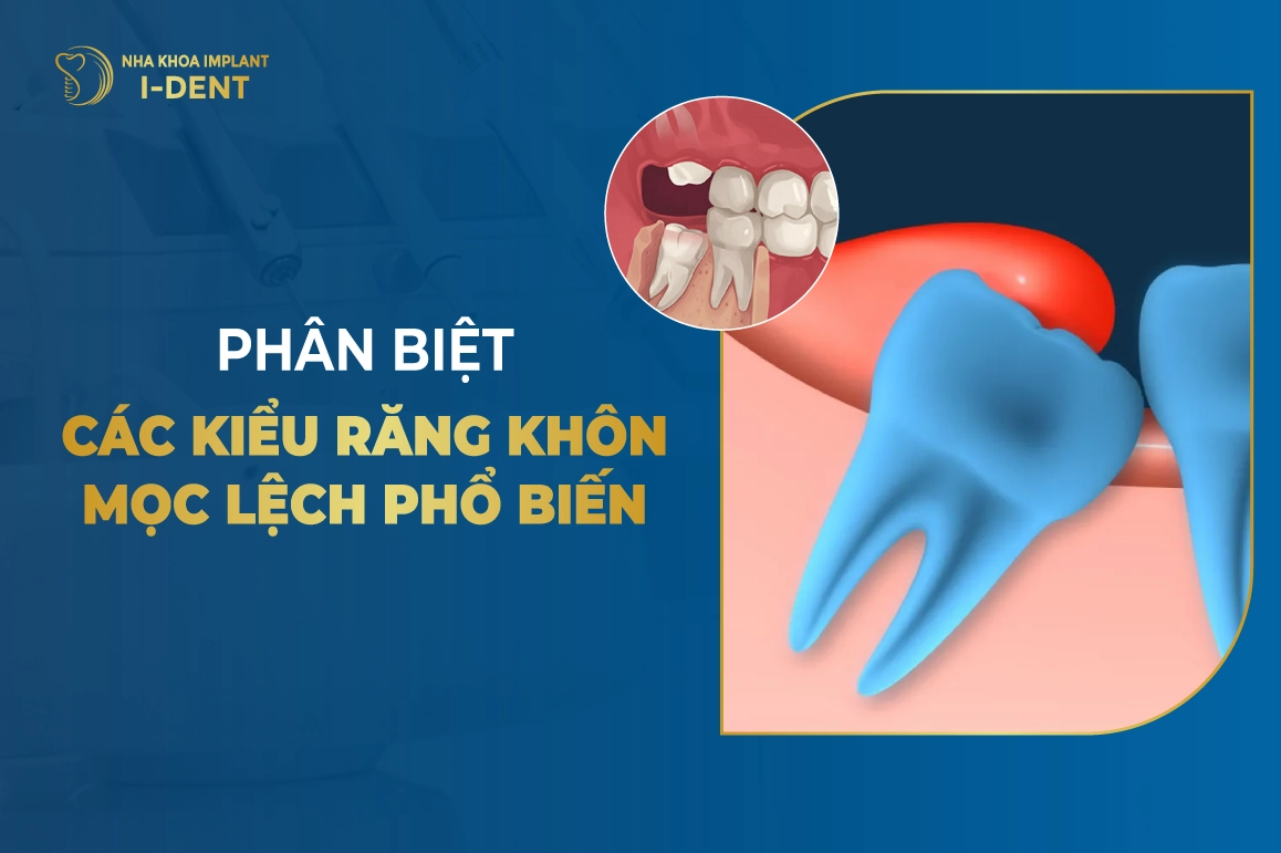 Phân Biệt Các Kiểu Răng Khôn Mọc Lệch Phổ Biến