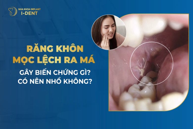 rang-khon-moc-lech-ra-ma-gay-bien-chung-gi