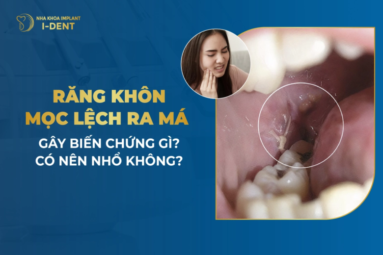 Răng Khôn Mọc Lệch Ra Má Gây Biến Chứng Gì? Có Nên Nhổ Không?