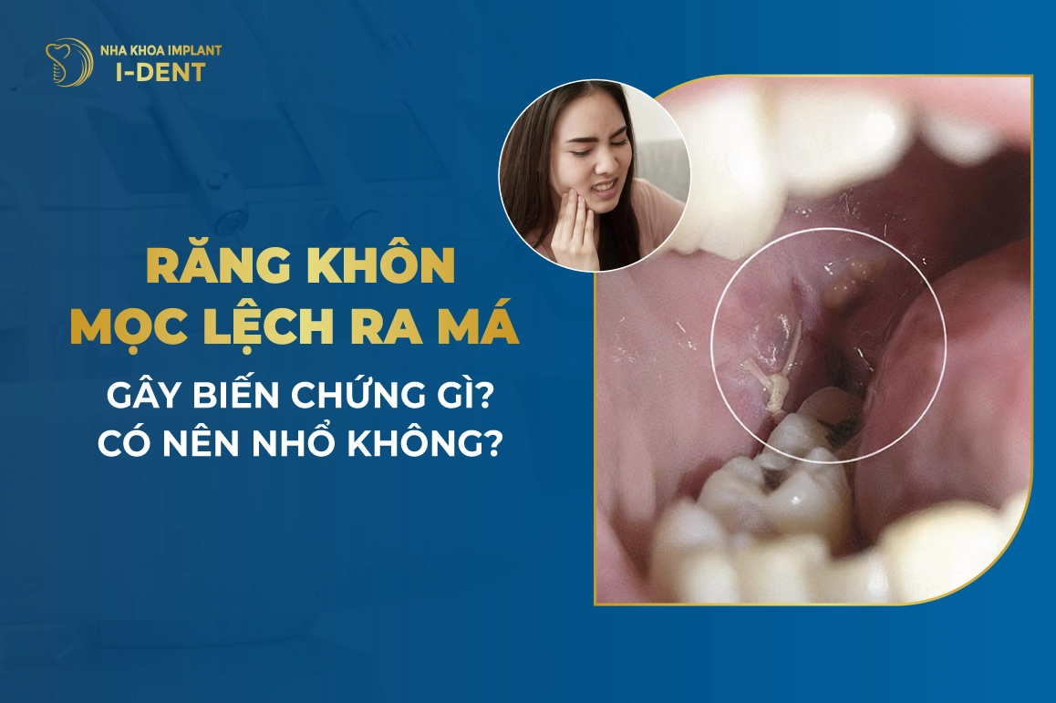 Răng Khôn Mọc Lệch Ra Má Gây Biến Chứng Gì? Có Nên Nhổ Không?