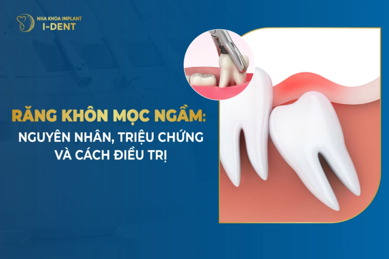 Răng Khôn Mọc Ngầm: Nguyên Nhân, Triệu Chứng Và Cách Điều Trị