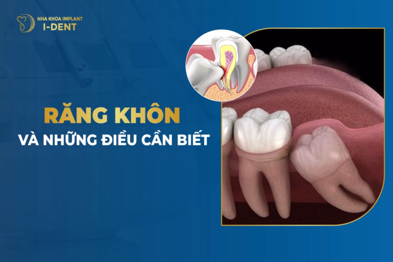 rang-khon-va-nhung-dieu-can-biet